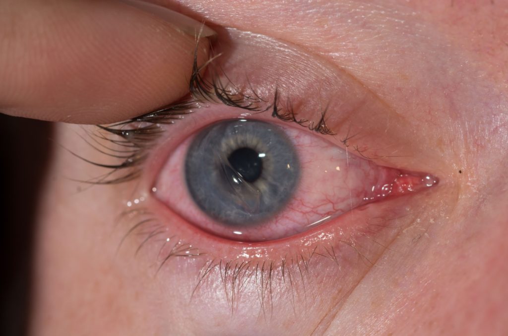 A close-up image of a red eye with a corneal scratch.