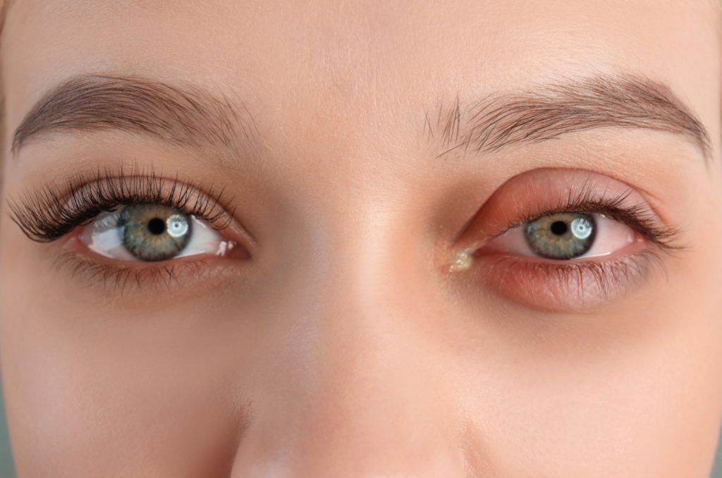 A close up image of both eyes with a red and inflamed left eye from pink eyes.