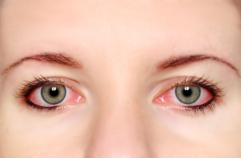 A woman's eyes appear red, hazy, and irritated from allergies.